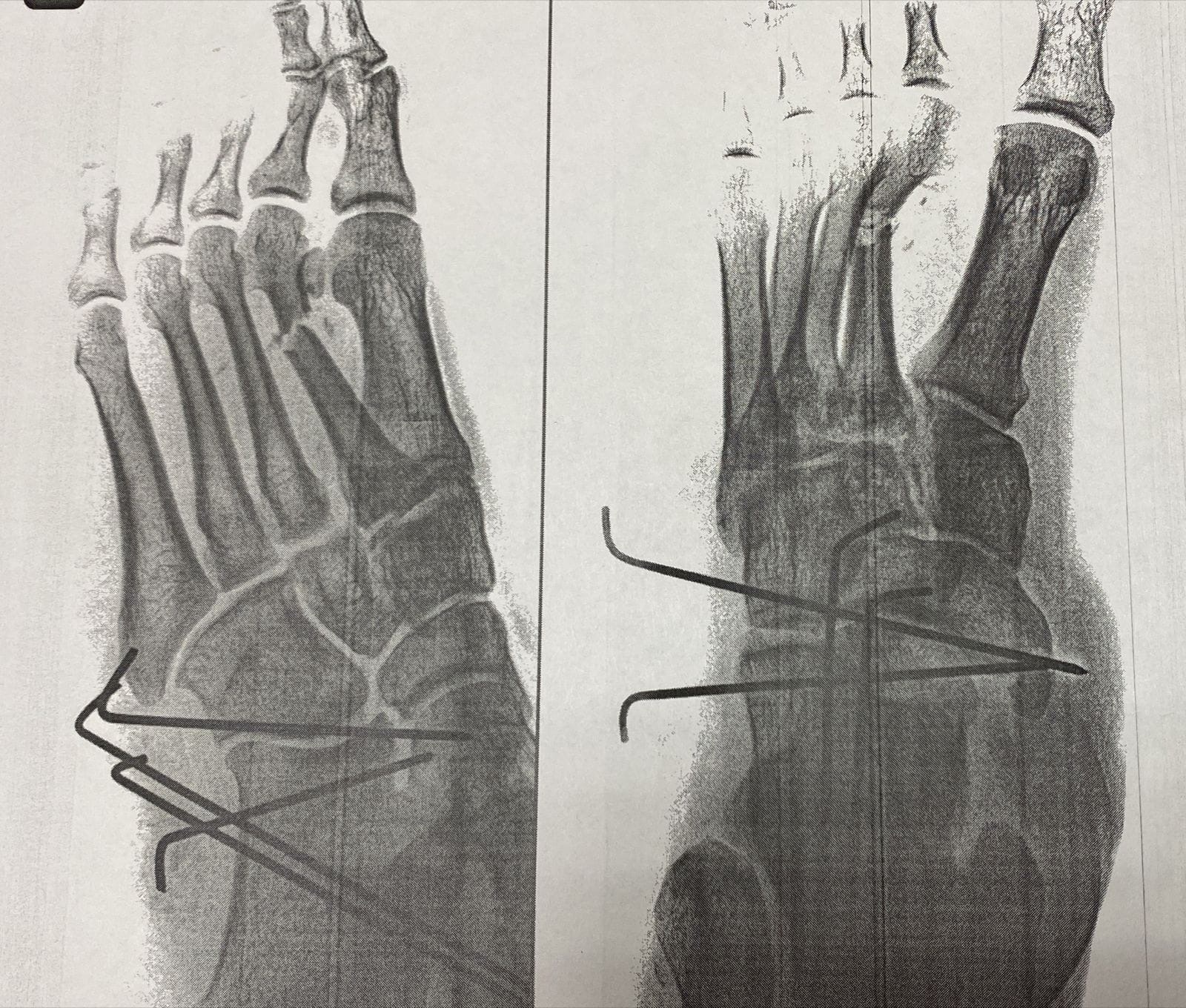 В Подольске мужчине спасли ногу после тяжелой травмы в ДТА
