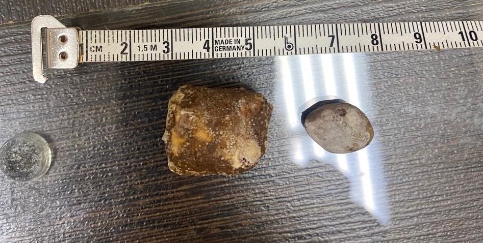 Двухсантиметровый камень удалили из почки жительницы Подольска