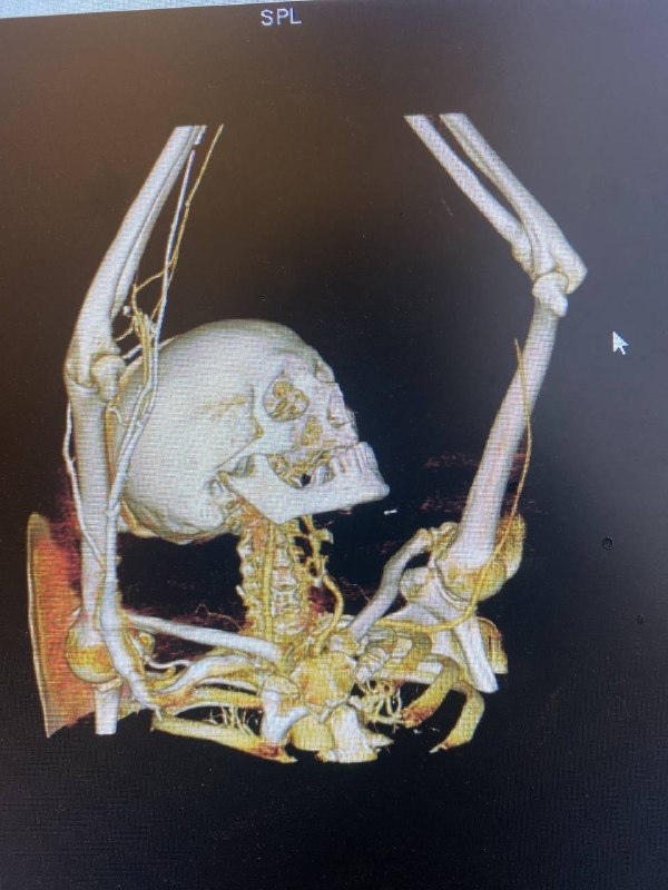 Пациента с острым тромбозом спасли в Подольске